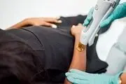 حکم شرعی لیزر بیکینی + نظر مراجع مختلف تقلید