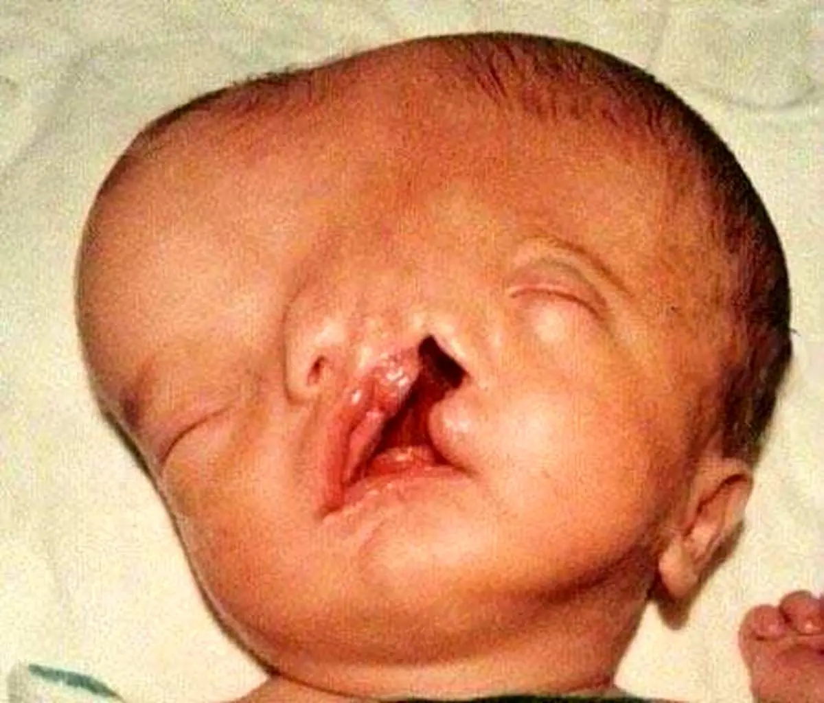 ببینید این پسر دو صورته در بزرگسالی چه شکلی شده+ عکس