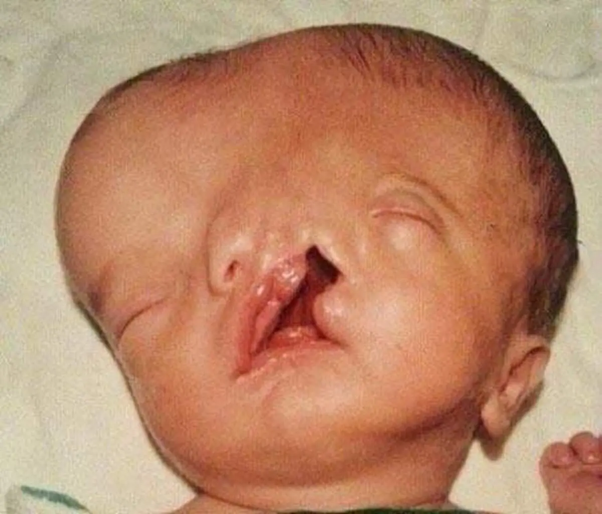 ببینید این پسر دو صورته در بزرگسالی چه شکلی شده+ عکس