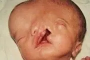 ببینید این پسر دو صورته در بزرگسالی چه شکلی شده+ عکس