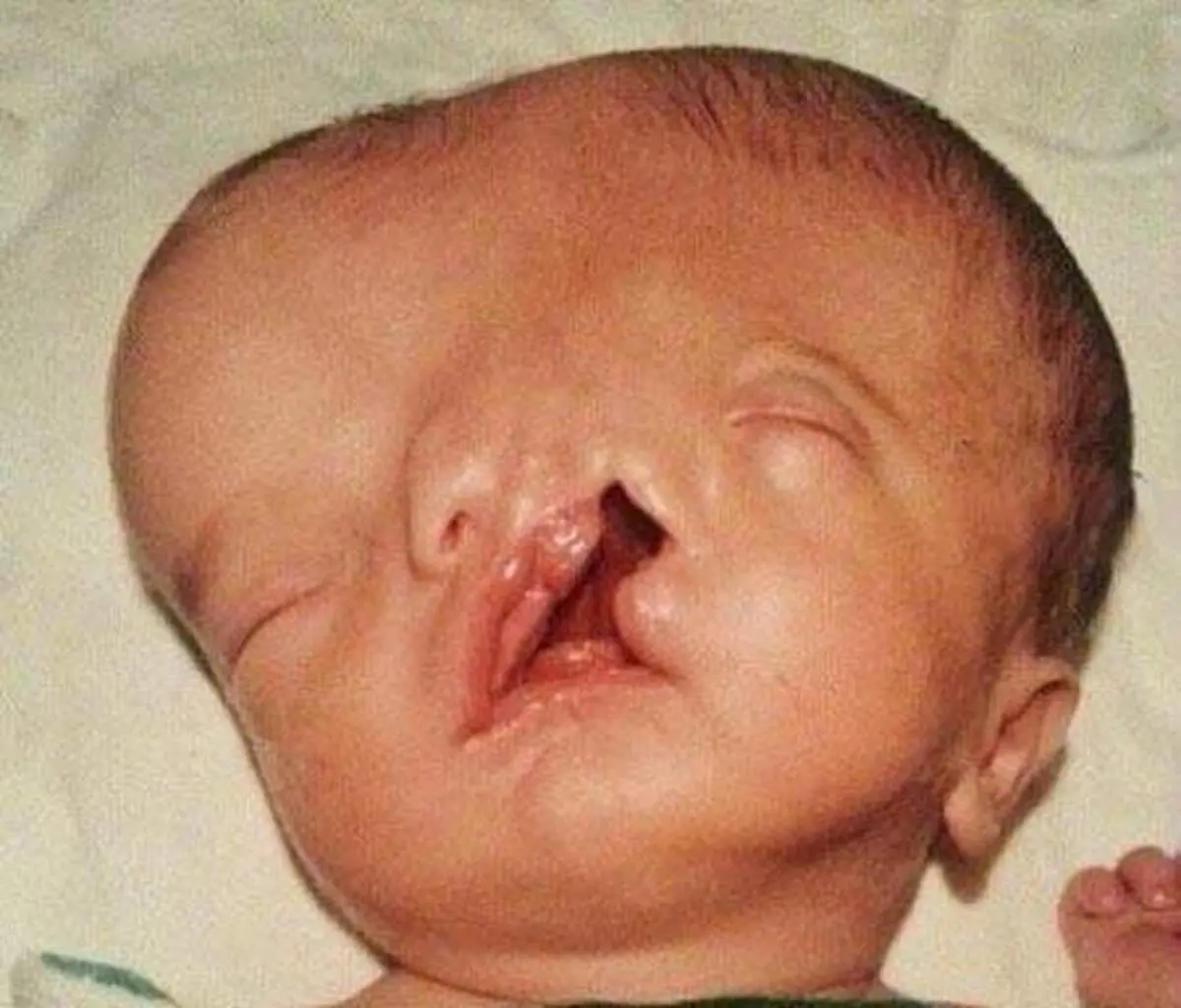 ببینید این پسر دو صورته در بزرگسالی چه شکلی شده+ عکس