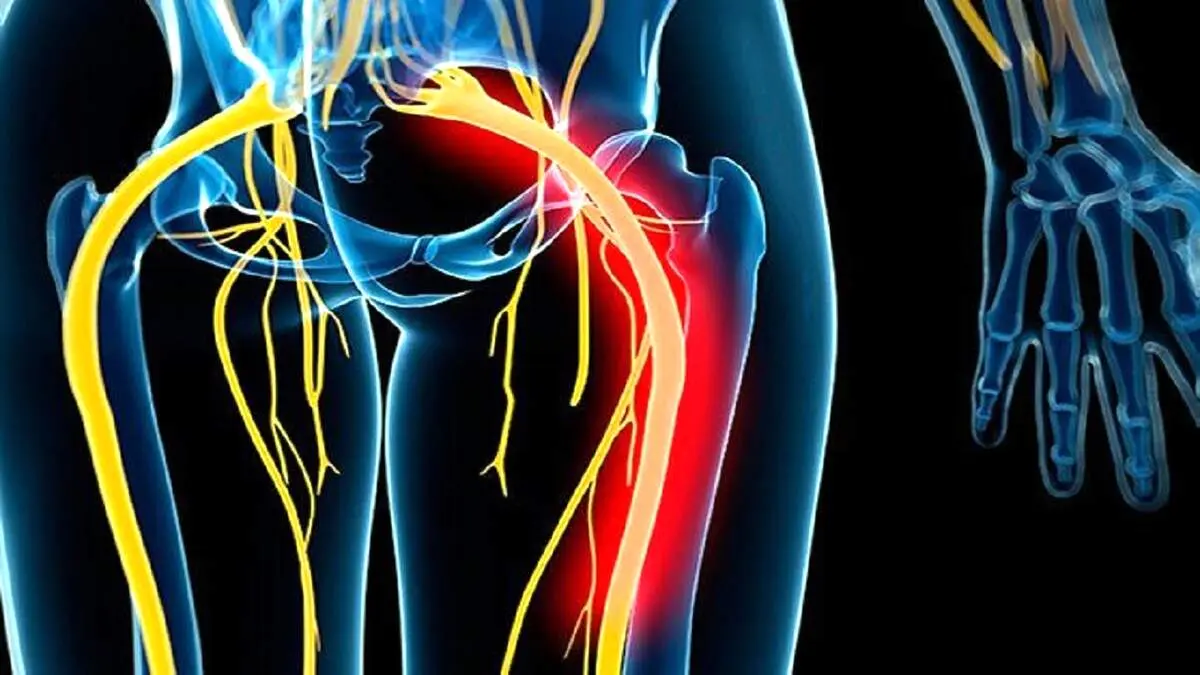 تفاوت بین درد سیاتیک و دیسک
