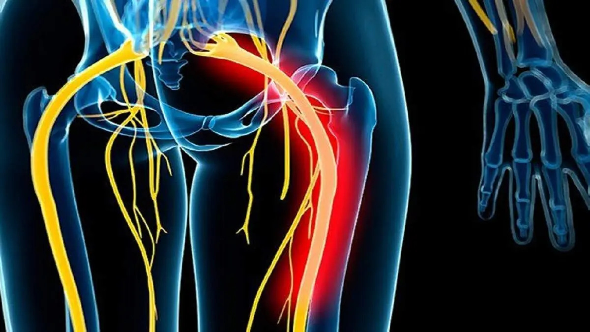 تفاوت بین درد سیاتیک و دیسک
