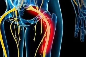 تفاوت بین درد سیاتیک و دیسک
