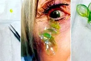 جا ماندن احمقانه ۲۳ لنز تماسی در چشم این زن!+عکس