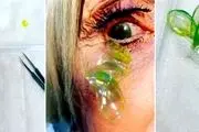 جا ماندن احمقانه ۲۳ لنز تماسی در چشم این زن!+عکس