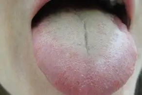 سفید شدن زبان نشانه‌ای از این بیماری است
