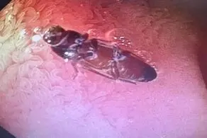 خارج کردن سوسک 3 سانتی از روده مرد جوان+عکس چندش آور