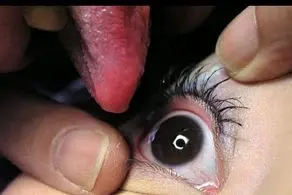 روش درمان ترسناک و چندش بیماری های چشم با لیس زدن + عکس عجیب درمان

