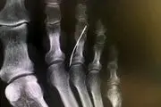 بی خبری از وجود سوزن خیاطی داخل پای این پیرزن! + عکس