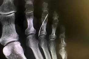 بی خبری از وجود سوزن خیاطی داخل پای این پیرزن! + عکس