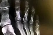 بی خبری از وجود سوزن خیاطی داخل پای این پیرزن! + عکس