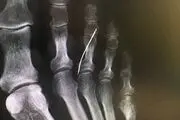 بی خبری از وجود سوزن خیاطی داخل پای این پیرزن! + عکس