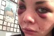 شکنجه و غل و زنجیر  دختر زیبا توسط دوست پسر مست+عکس آثار شکنجه