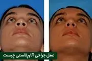 آلارپلاستی چیست و چگونه انجام می‌شود؟