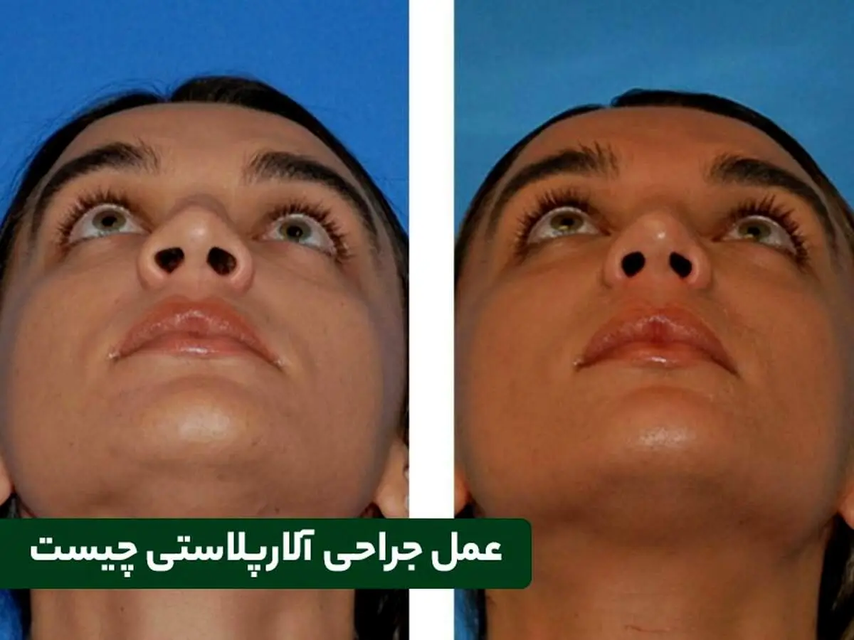 آلارپلاستی چیست و چگونه انجام می‌شود؟