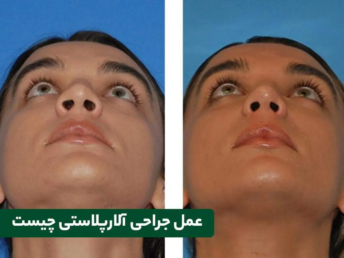 آلارپلاستی چیست و چگونه انجام می‌شود؟