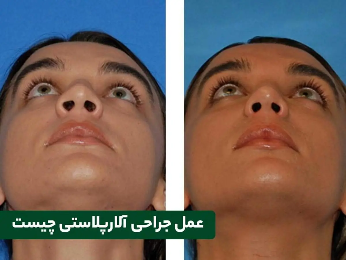 آلارپلاستی چیست و چگونه انجام میشود؟
