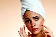 چند بیماری پوستی که با جوش اشتباه گرفته می‌شود!