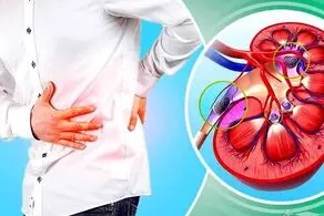 ترکیبات طبیعی برای نابودی سنگ‌های کلیوی
