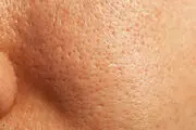 درمان قطعی سندرم پوست پرتقالی