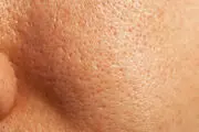 درمان قطعی سندرم پوست پرتقالی