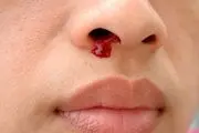  هشدار  جدی؛ با مصرف زیاد این ویتامین دچار خونریزی می‌شوید!