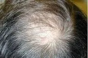 اشتباهاتی که افراد کم مو مرتکب می‌شوند!