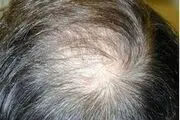 اشتباهاتی که افراد کم مو مرتکب می‌شوند!