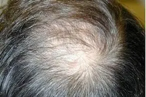 اشتباهاتی که افراد کم مو مرتکب می‌شوند!