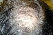 علت اصلی ریزش موهای شما حتما یکی از این 20 دلیل است +راه حل عملی