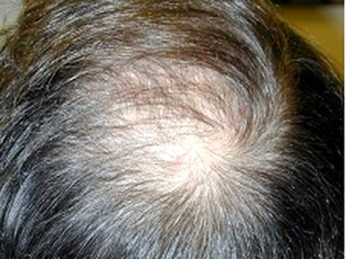علت اصلی ریزش موهای شما حتما یکی از این 20 دلیل است +راه حل عملی