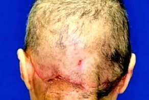 کنده شدن کامل پوست سر این زن بیچاره+ عکس