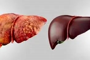  یک باور اشتباه رایج در خصوص کبد چرب