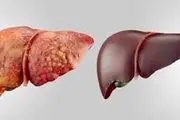 کبد چرب چند گرید دارد و علائم هر کدام از گریدها چیست؟/ تصاویر عجیب و واقعی


