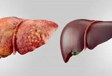 افراد لاغر هم کبد چرب دارند