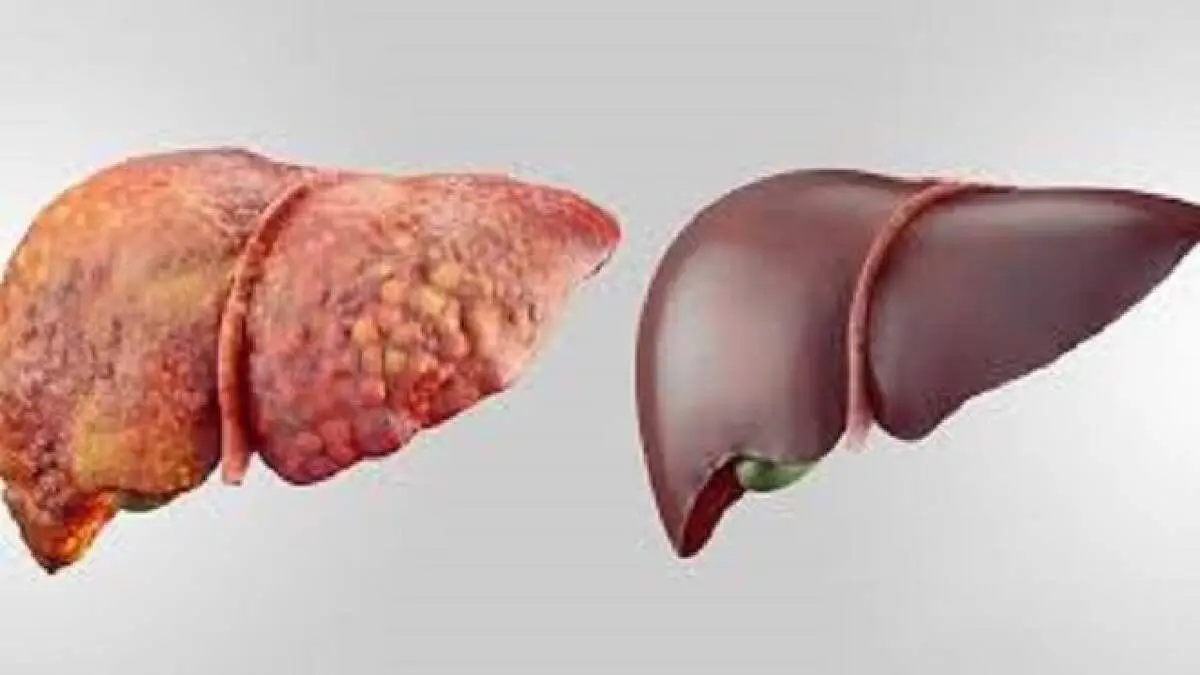 این تغییرات در کف دست‌ها نشانه بیماری کبدی است