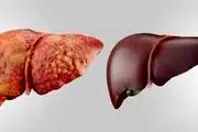کبد چرب چند گرید دارد و علائم هر کدام از گریدها چیست؟/ تصاویر عجیب و واقعی

