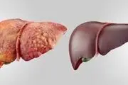 کبد چرب چند گرید دارد و علائم هر کدام از گریدها چیست؟/ تصاویر عجیب و واقعی

