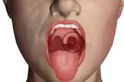 این علایم خطرناک در دهان از ابتلا به سرطان خبر می‌دهند
