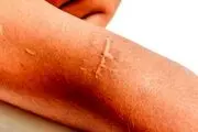 نحوه محوکردن جای بخیه!