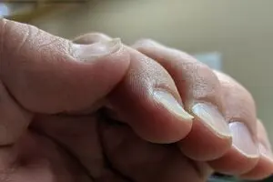 در مورد ناخن قاشقی چه می دانید؟

