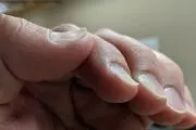 در مورد ناخن قاشقی چه می دانید؟

