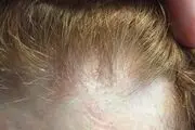نابودی موها با این روش‌های غلط