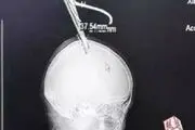 حرکت جنجالی زنی که قیچی داخل سرش فرو رفته بود! + عکس