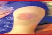 تنبیه بدنی شدید دانش آموز کلاس سوم