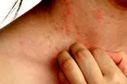 با خوردن این خوراکی‌ها به خارش می‎افتید