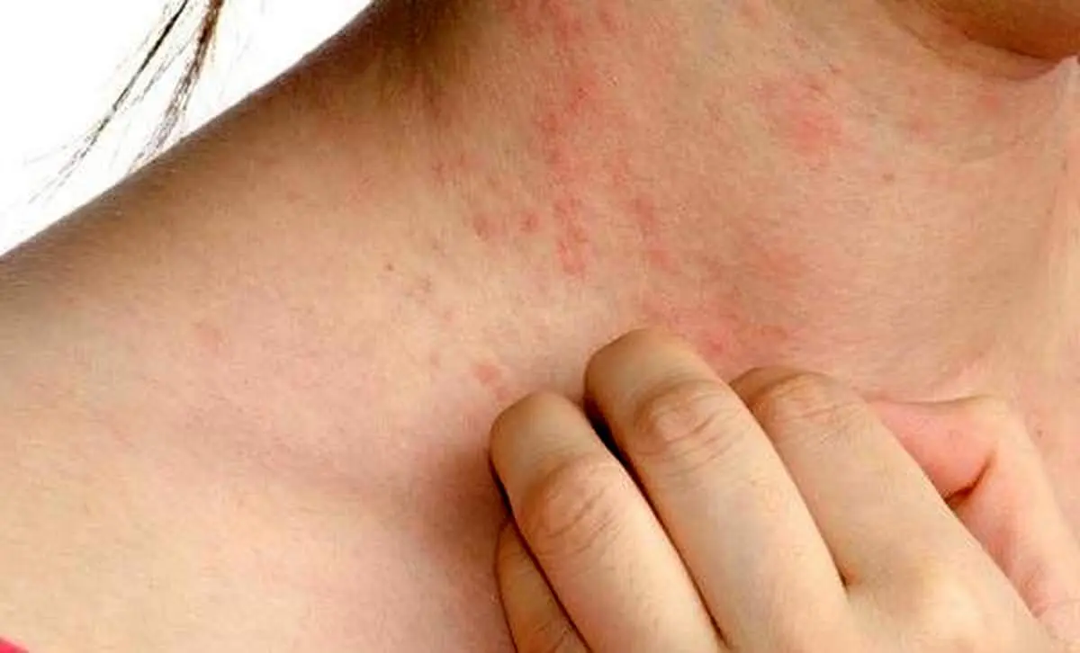 با خوردن این خوراکیها به خارش میافتید