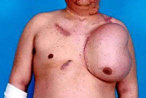 رشد کردن یک صورت جدید بر روی سینه این مرد/عکس +18