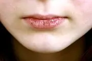 دلایل عجیب خشکی بیش از حد دهان
